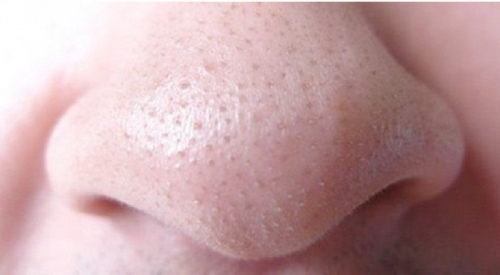 'Đánh bay' sợi bã nhờn, ngăn ngừa mụn đầu đen