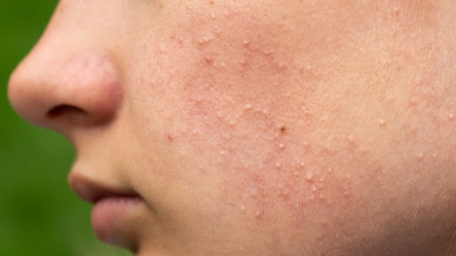 5 phương pháp trị mụn ẩn đơn giản hiệu quả bất ngờ