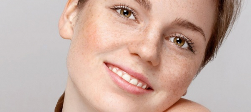 Phân biệt nám và tàn nhang bằng những dấu hiệu dễ thấy