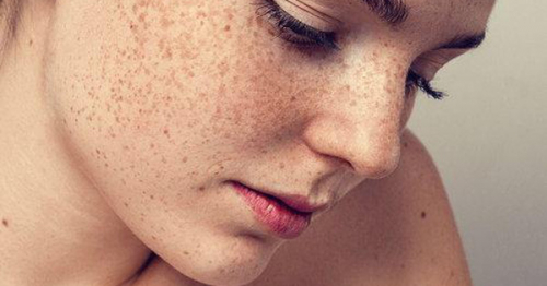 Nguyên nhân gây nám da mặt ở phụ nữ