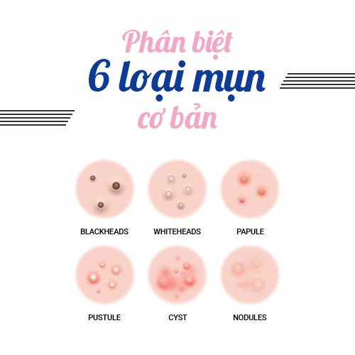 Kem trị mụn ẩn được tin dùng nhất hiện nay