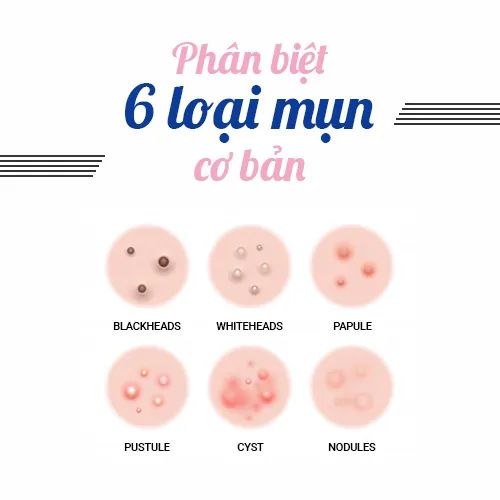 Kem trị mụn ẩn được tin dùng nhất hiện nay