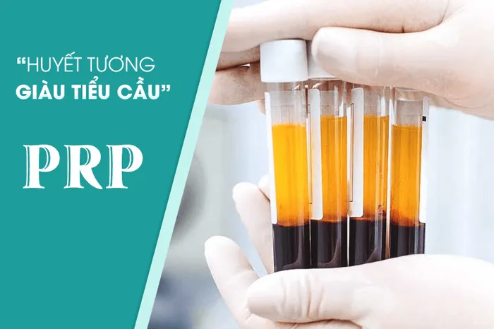 Điều trị đau bằng huyết tương giàu tiểu cầu (PRP)