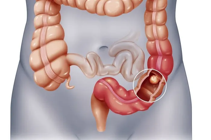 Các triệu chứng cảnh báo tắc ruột