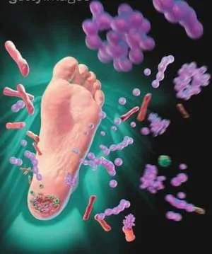 Loét da ở người cao tuổi