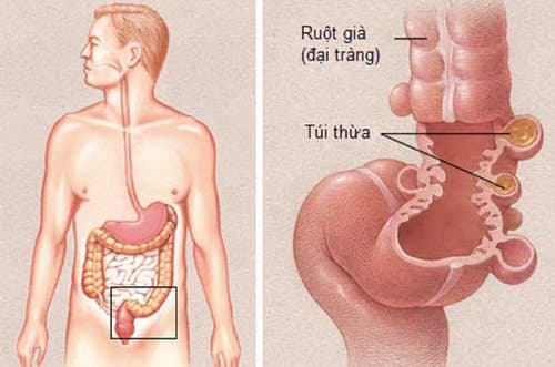 Điều trị túi thừa đại tràng biến chứng