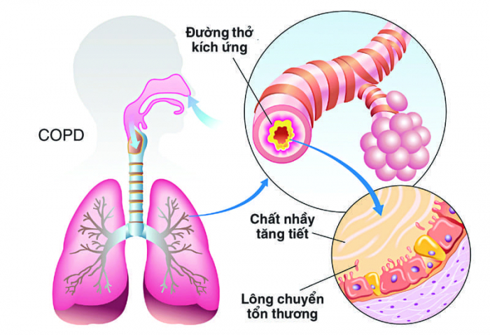 Bệnh phổi tắc nghẽn COPD và ung thư phổi