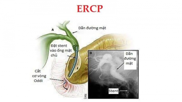 Nội soi mật tụy ngược dòng giúp chẩn đoán bệnh gì?