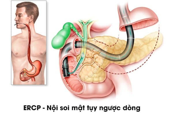 Nội soi mật tụy ngược dòng được thực hiện như thế nào?