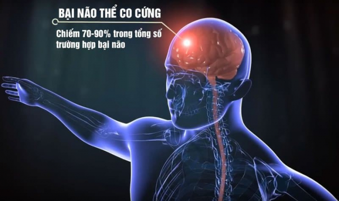 Chẩn đoán bại não thể co cứng