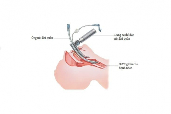 Đặt nội khí quản được chỉ định trong trường hợp nào?