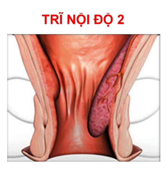 Trĩ nội độ 2 điều trị thế nào?