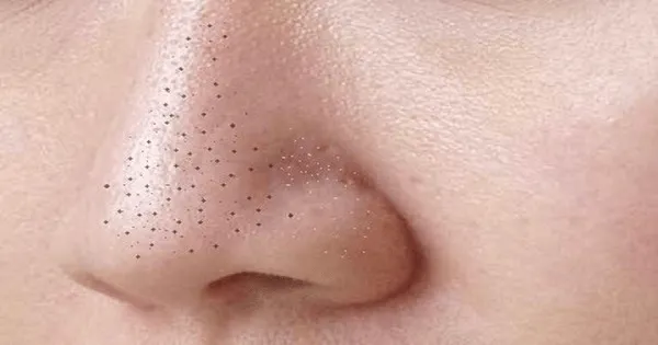  Trị dứt mụn đầu đen tưởng khó mà dễ không ngờ
