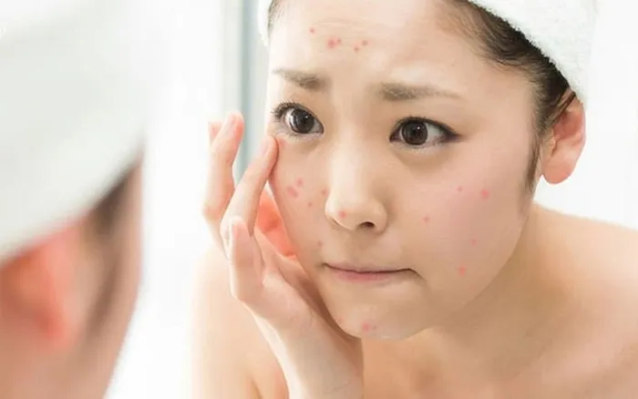 Thứ này thường được cho là để trị mụn nhưng kỳ thực tai hại