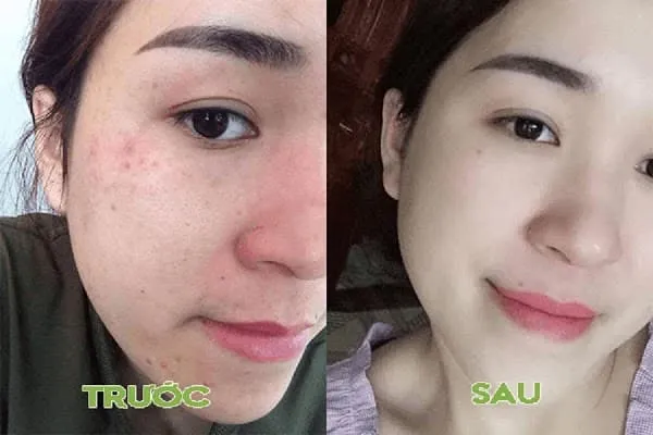 Có ngay công thức xóa sạch tàn nhang, nám vĩnh viễn