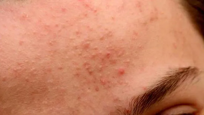 Nguyên nhân và cách phòng ngừa mụn ẩn ở dưới da