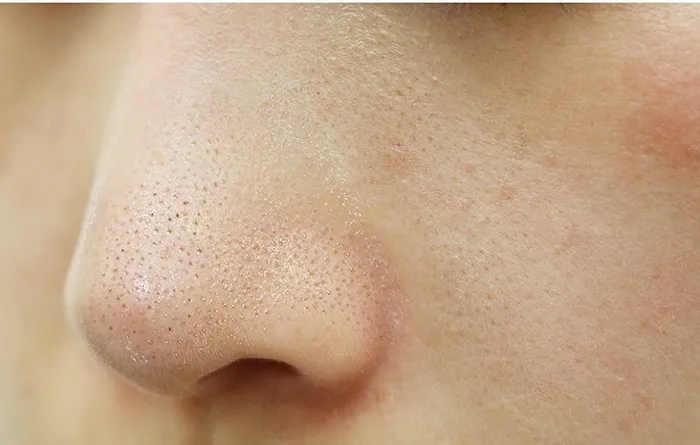 Nguyên nhân gây mụn cám và cách trị mụn hiệu quả