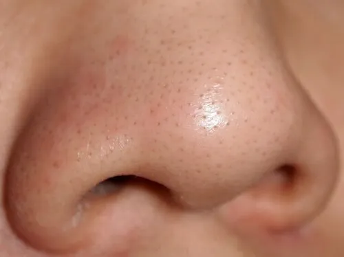 Trị mụn đầu đen sau 1 tuần chỉ với một trái chanh