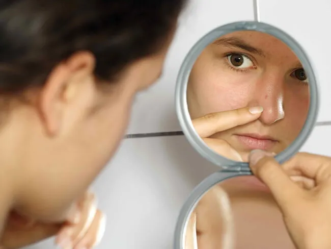 Cách trị mụn đầu đen tận gốc tại nhà đúng cách