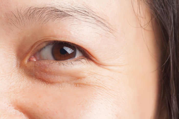 Nguyên nhân và cách ngăn ngừa nếp nhăn dưới mắt hiệu quả