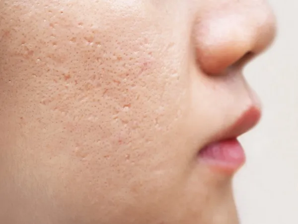 Top 4 phương pháp trị sẹo rỗ lâu năm đơn giản, hiệu quả nhất